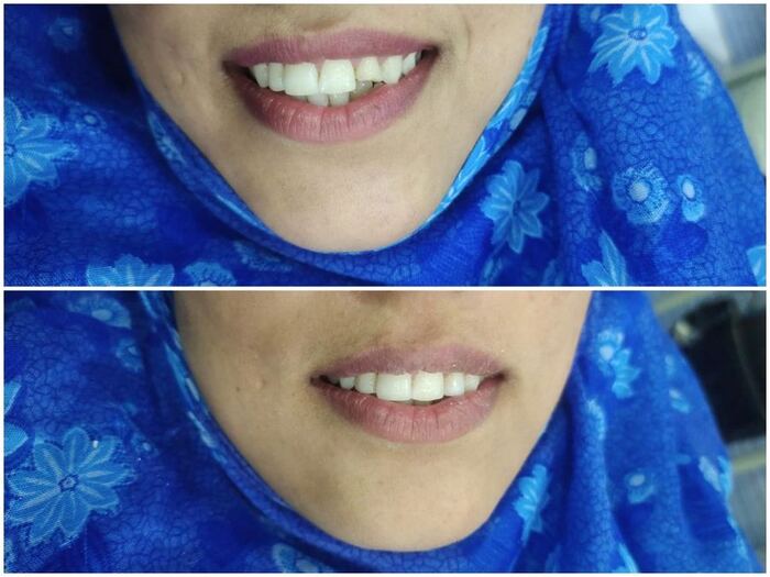 Composite edge bonding before and after