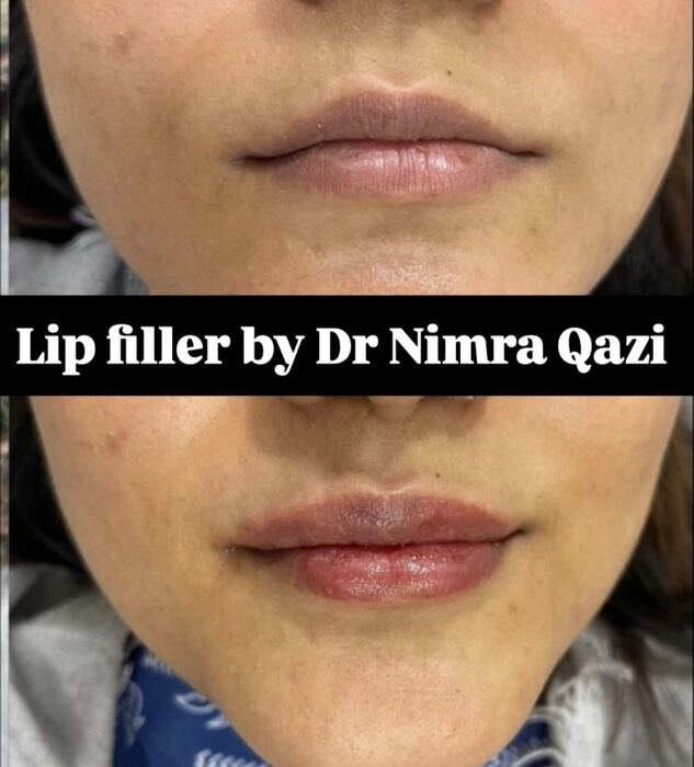 Lip Filler before and after