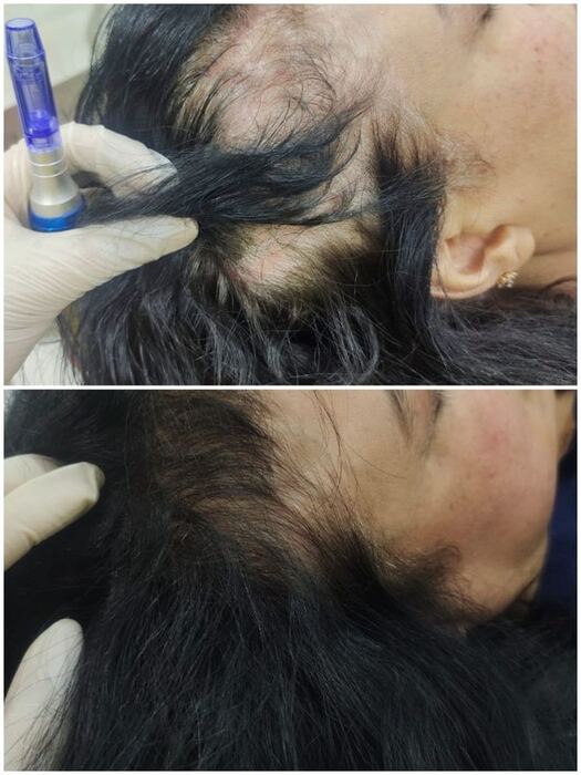 PRP Hair Treatment before and after