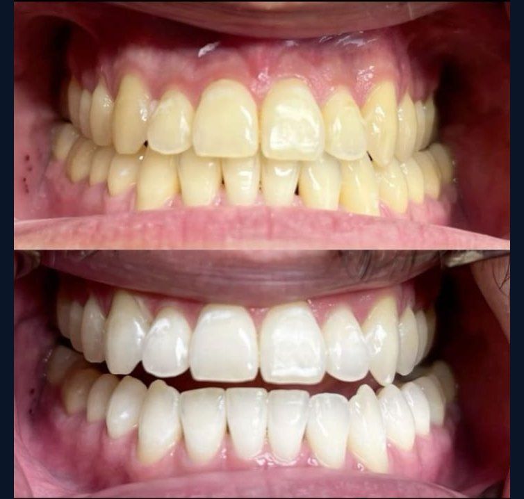 Smile brightening before and after result
