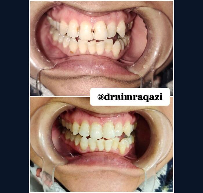 Teeth whitening before and after result